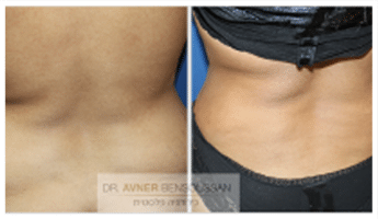 תמונה להמחשה לפני ואחרי מתיחת בטן 00012