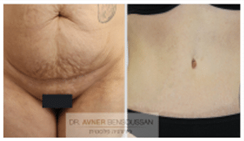תמונה להמחשה לפני ואחרי מתיחת בטן 00016