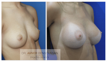 ניתוח הגדלת חזה לפני ואחרי