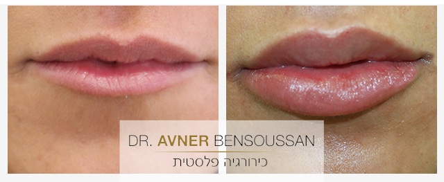 תמונה להמחשה לפני ואחרי עיבוי שפתיים