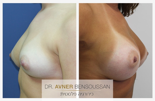ניתוח הגדלת חזה לפני ואחרי - ד"ר אבנר בן שושן
