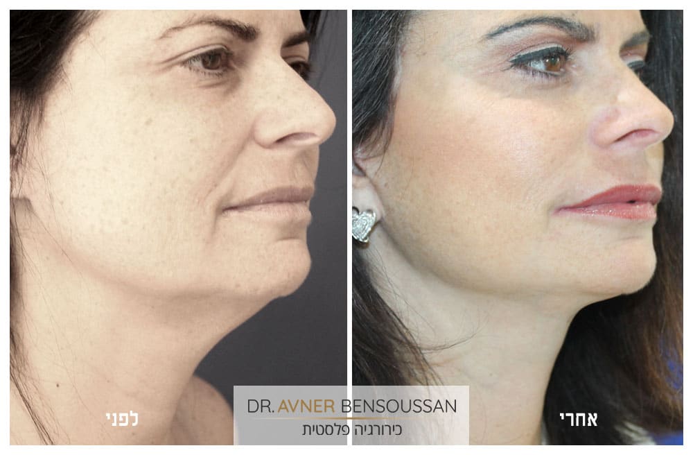 תמונה של מתיחת פנים לפני ואחרי טיפול